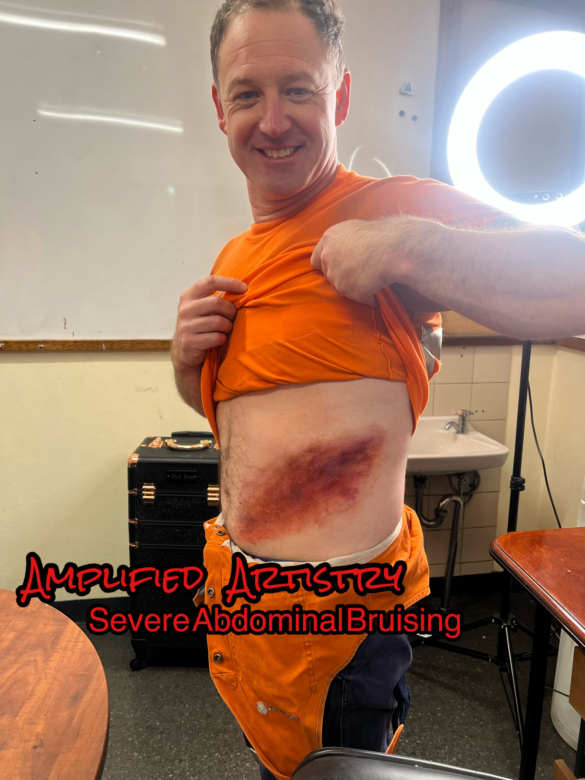 Severe Abdominal Bruising Make Up for a Fake Injury Mines Rescue Competition